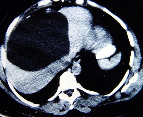 Liver Cyst 2747 Liver Cyst Non Neoplastic 7 | Surgery Photos