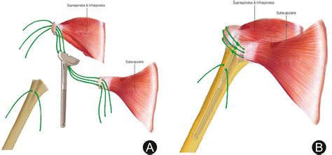 Technique Of Tuberosity Repair Followed In This Study A A Set With 3