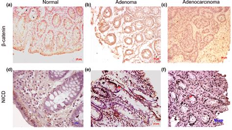 Immunohistochemical Analysis Of B Catenin In Colorectal Tissues Download Scientific Diagram