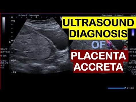 Ultrasound Diagnosis Of Placenta Accreta Youtube