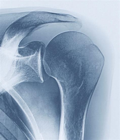 Fracture Of The Upper Arm Photograph by Zephyr/science Photo Library ...