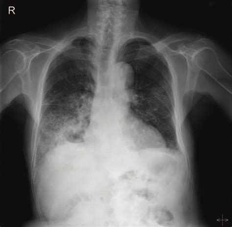 Chest Radiography Indicates Increased Opacities In The Right Lower Lung