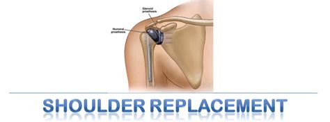 Shoulder Replacement Surgery In Karnal Id 7525940155