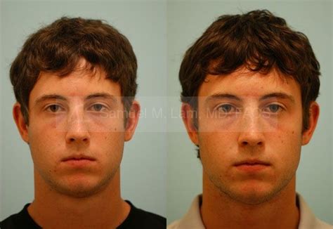 Corrective Male Rhinoplasty Photo Traumatic Nose Injury Bulbous