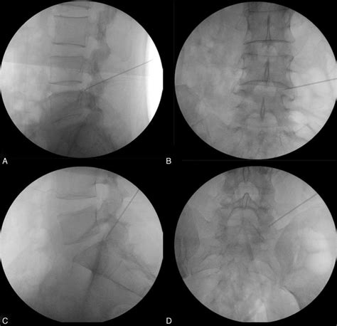 Intraoperative Fluoroscopic Images Showing The Modified Technique Download Scientific Diagram