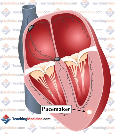 Ventricular Tachycardia Also Known As Vt Is Caused By A Pacemaker In The Ventricles