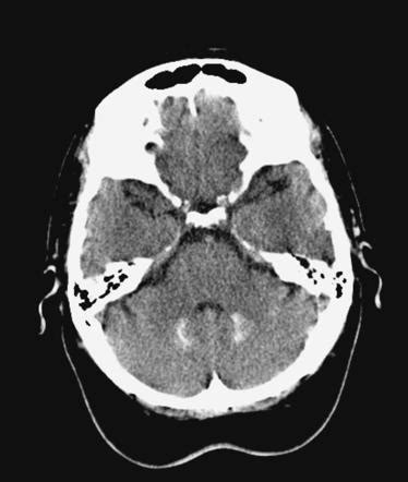 Spinocerebellar Ataxia Mri