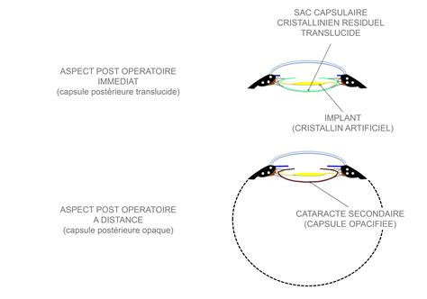 Cataracte Secondaire Laser YAG Centre Ophtalmologique Agora