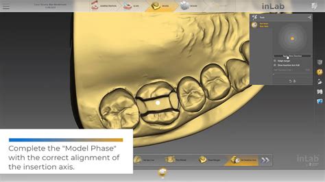 Cerec Tessera Processing Inlab Cad Sw Youtube