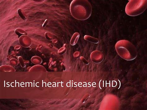 Ischemic Heart Disease Ihd Pathophysiology Types Its Causes And