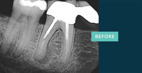 Root Canal Before And Afters Midtown Endodontist Nyc