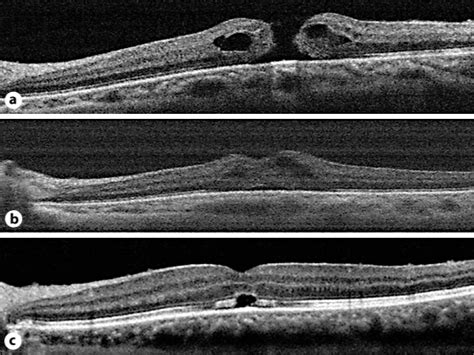 SD-OCT images of a macular hole from case 1. a Macular hole after ILM... | Download Scientific ...