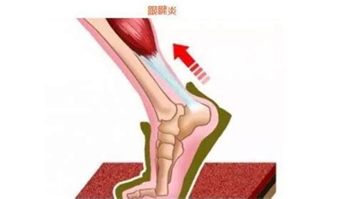 有跟腱炎該怎麼辦？ 每日頭條