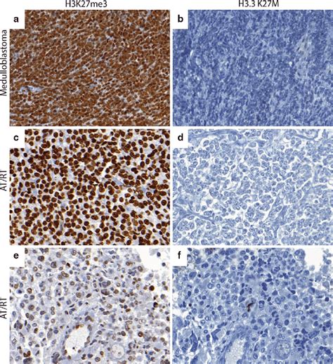 Comparison Of H K Me And H K M In Cns Embryonal Tumors A B