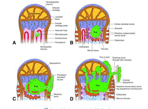 Landscape Of Bone Pathology Flashcards Quizlet