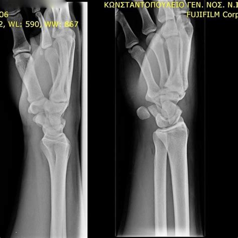 Scaphoid Fracture Classification According To Herbert And Fischer