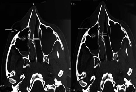 Computed tomography (CT) showed blowout fracture of the inferior ...