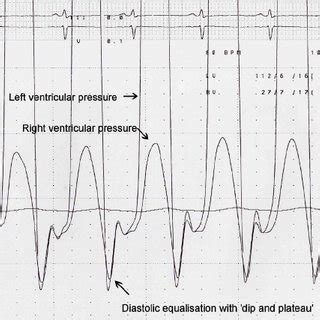 simultaneous left   ventricular pressure recordings
