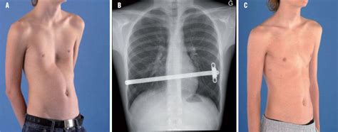 Forensische Medizin Ordnen Genau Thorax En Entonnoir Gr Ner Hintergrund