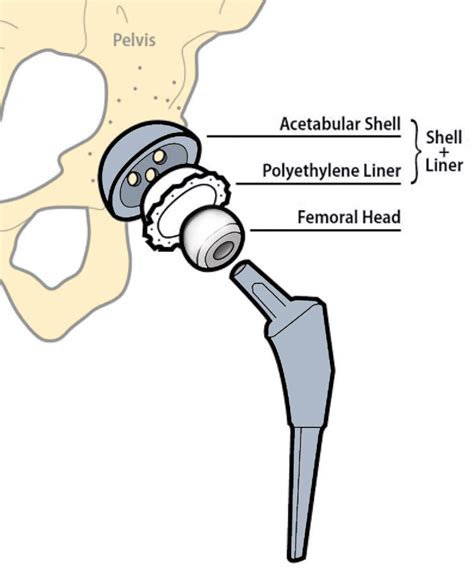 Schematic Diagram Of A Total Hip Replacement Indicating The Different Download Scientific