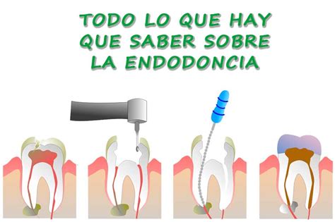 La Endodoncia En Un Caso Real Clínica Dental Rehberger López Fanjul