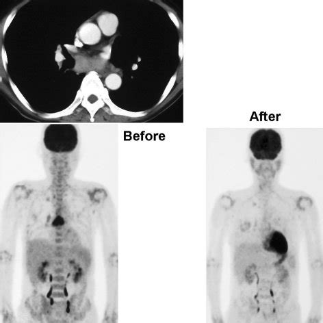 chest ct showing enlargement   subcarinal lymph node  fdg pet