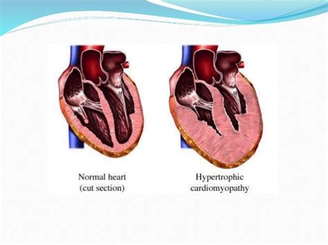 Hcm Presentation Hemodynamics Vand Intervention