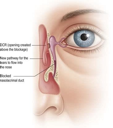 Nasolacrimal Duct Obstruction Ophtnotes