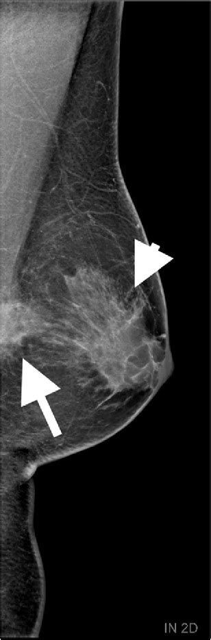 Figure 1 From Desmoid Fibromatosis In A Male Breast With Gynecomastia