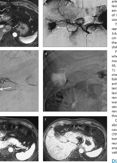 Figure From Transarterial Embolization With Bleomycin For Symptomatic