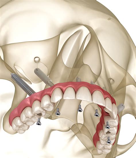 Zygoma Pterygoid Implants Star Dental Implants