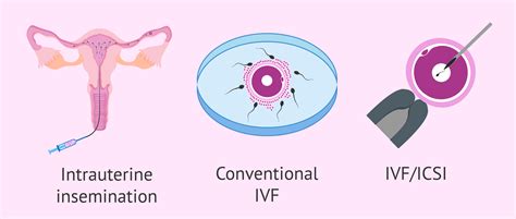 In Vitro Fertilization Ivf What Is It And How Much Does Off