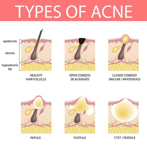 What Causes Acne And Pimples