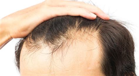 Qué Es La Calvicie Y Qué Tratamientos Existen Salud Alopecia Calvicie