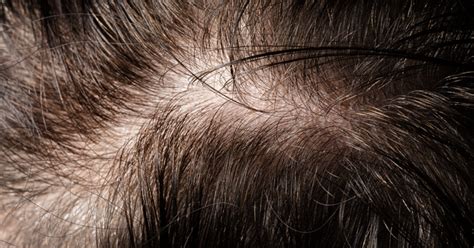 Traction Alopecia Symptoms Causes And Treatment Options Andsons Sg