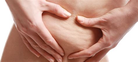 Diff Rents Types De Cellulite Conseils Et Traitement Jfg Clinic