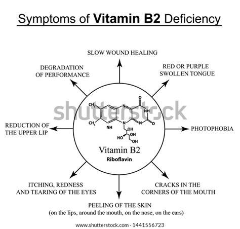 Symptoms Vitamin B2 Deficiency Infographics Illustration Stock