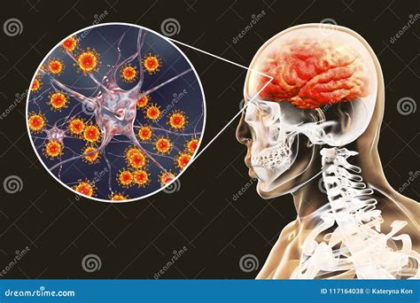 Viral Meningitis And Encephalitis Medical Concept Stock Illustration