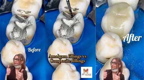 Amalgam Fillings VS Composite Fillings YouTube