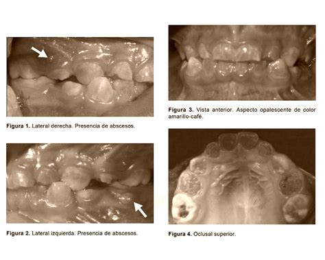 Qué es la Dentinogénesis imperfecta Reporte de un caso OdontoVida