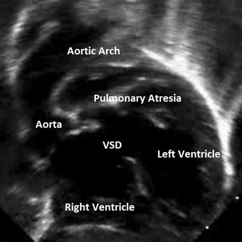 Bilateral Patent Ductus Arteriosus Pda Arising From Separate Origins