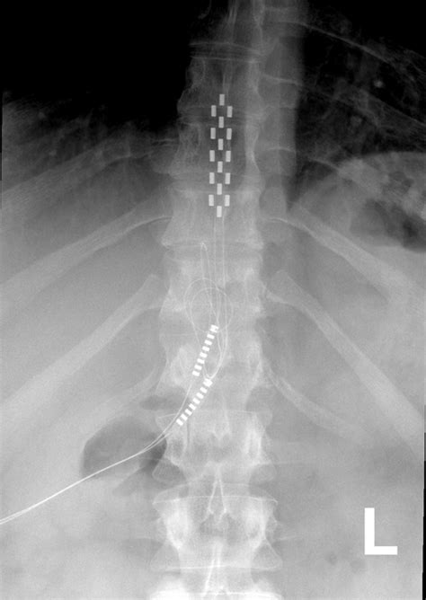 Spinal Cord Stimulation Doesnt Help With Bac Eurekalert