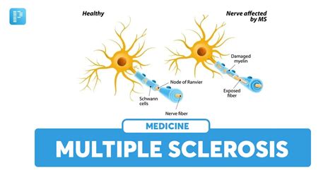 Multiple Sclerosis Pathophysiology Clinical Features