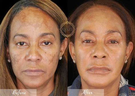 Can Hydroquinone Make Dark Spots Worse