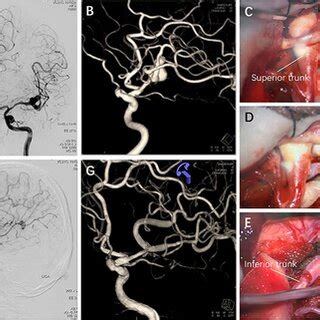 Preoperative And Postoperative Images And Intraoperative Findings Of