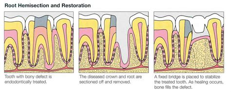 Tooth hemisection