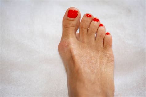 Hallux Rigidus—common Causes Symptoms And Treatment Custom Orthotics Blog Upstep