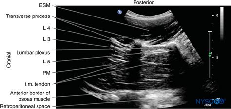 Regional Anesthesia Sagittal Sonogram Of The Lumbar Paravertebral