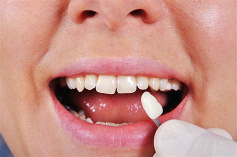Misshaped Teeth Porcelain Veneers Warsaw In Cosmetic Dentistry