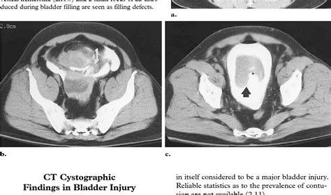 Figure 2 From Ct Cystography In The Evaluation Of Major Bladder Trauma
